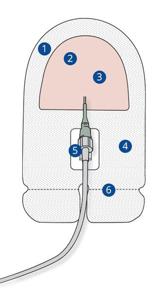 Securis™ Stabilization Device incorporates six design features.