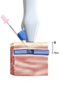 Site-Rite Needle Guide